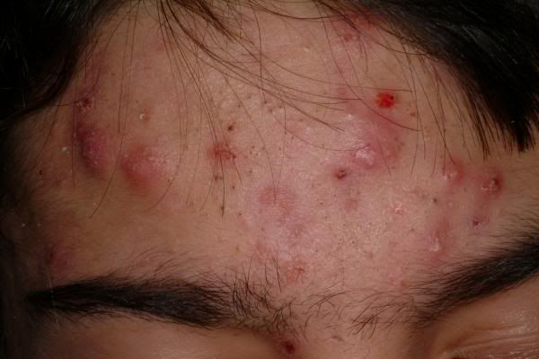 acne photo acne_cystic.jpg